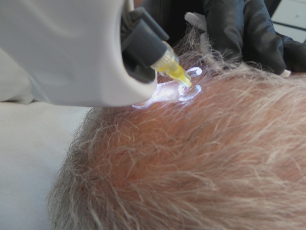 PrP haarbehandeling
