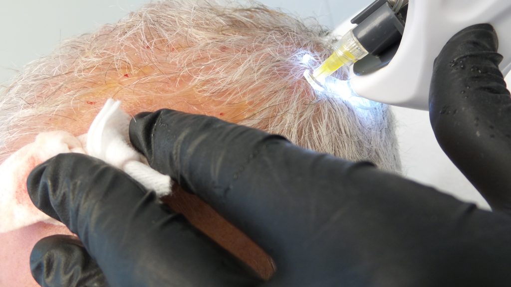 prp haarbehandeling