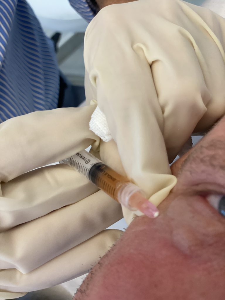 prp behandeling 